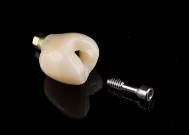 Restoring Dental Implants: From Digital Impression to Final Restoration
