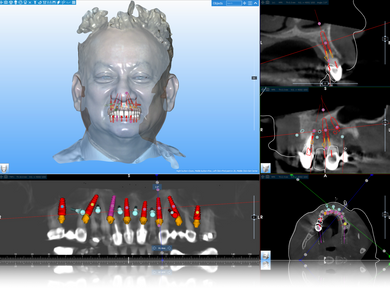 Advanced Concepts in Full-Arch Implant Restoration: FP1 Workflows - Mastering Esthetics, Soft Tissue, and Precision Fit