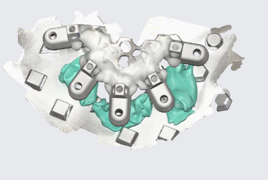 All-on-X FP3 Fundamentals: Modern Full-Arch Workflow - Start-to-Finish Techniques for Predictable Fixed Implant Restorations