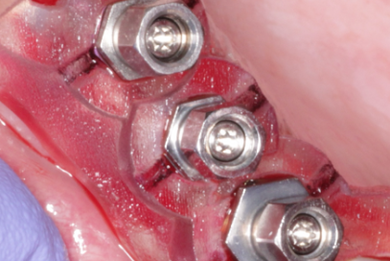 Guided Implant Surgery: Digital Workflows for Safe and Efficient Implant Placement