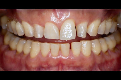 Esthetic Techniques with Anterior Crowns and Veneers