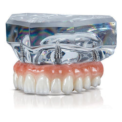 BruxZir® Esthetic Implant Prosthesis Sample Clear Base w/ Implants