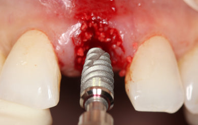 Surgical Placement of Dental Implants: A Restorative-Driven Approach