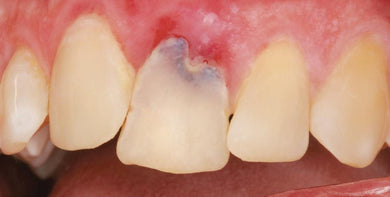 The Emergency Implant: Immediate Implant Placement in Extraction Sockets – Safe, Simple and Predictable