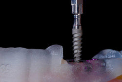 Implant Surgery: A Comprehensive Review Utilizing Freehand and Guided Techniques